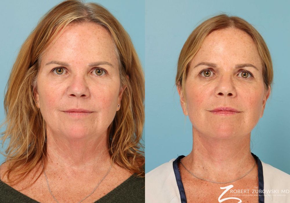 Neck Lift - Case 3852