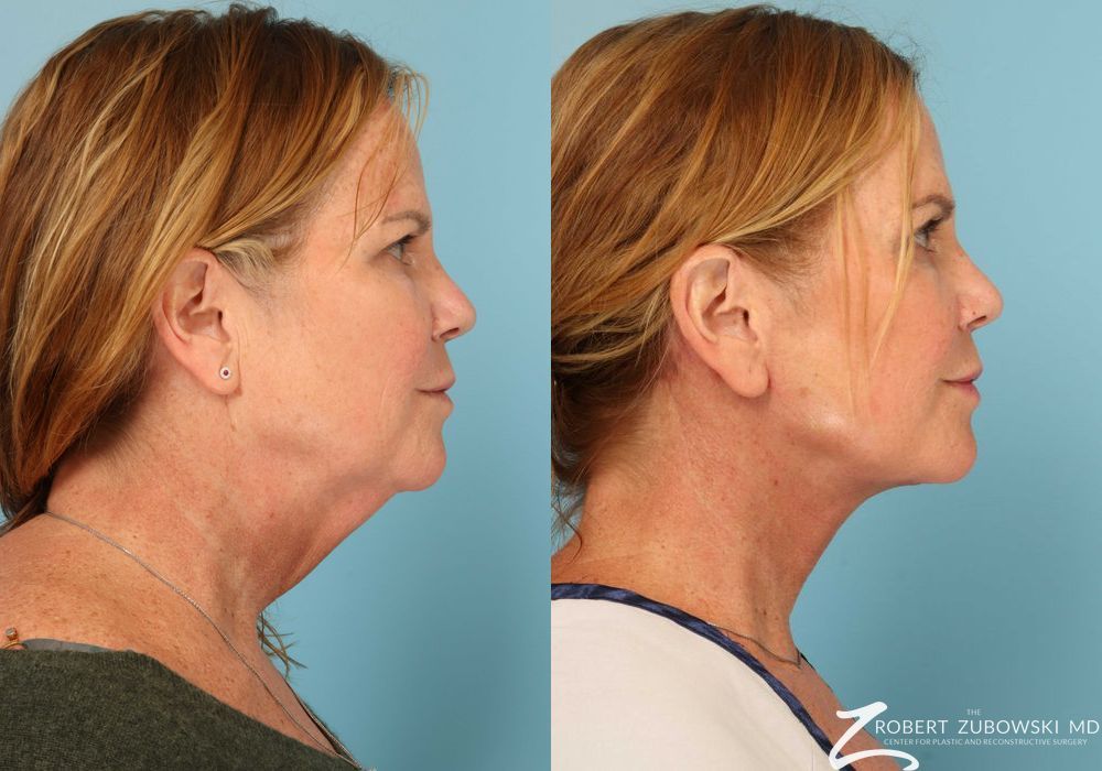 Neck Lift - Thumbnail 2
