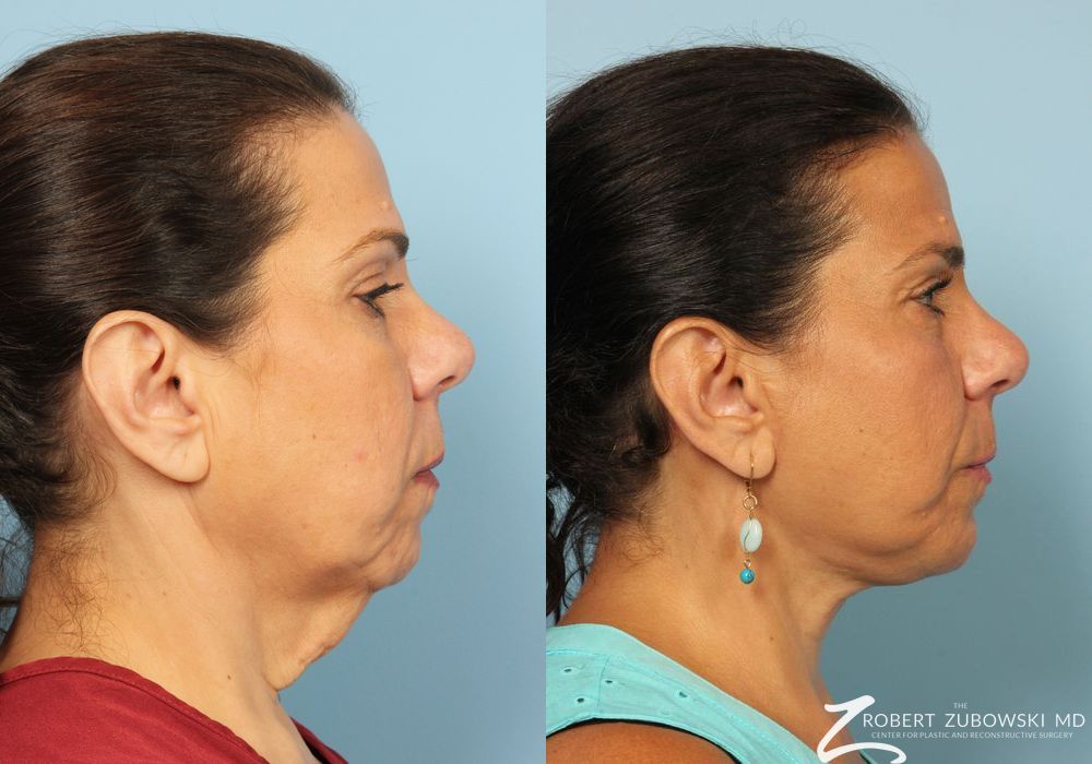 Neck Lift - Thumbnail 2