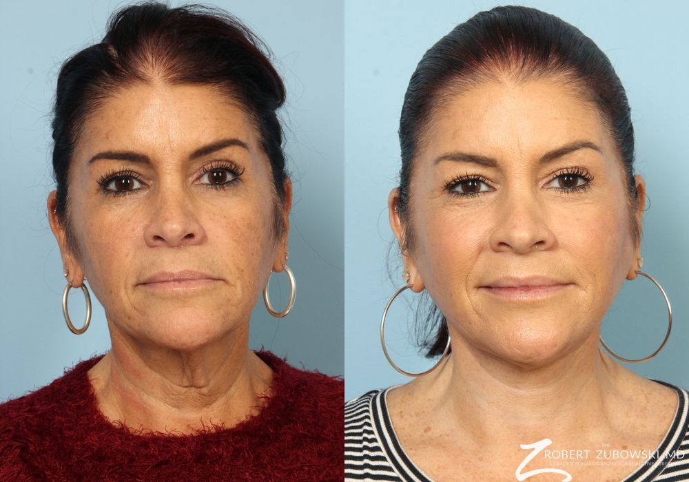 Neck Lift - Case 3851