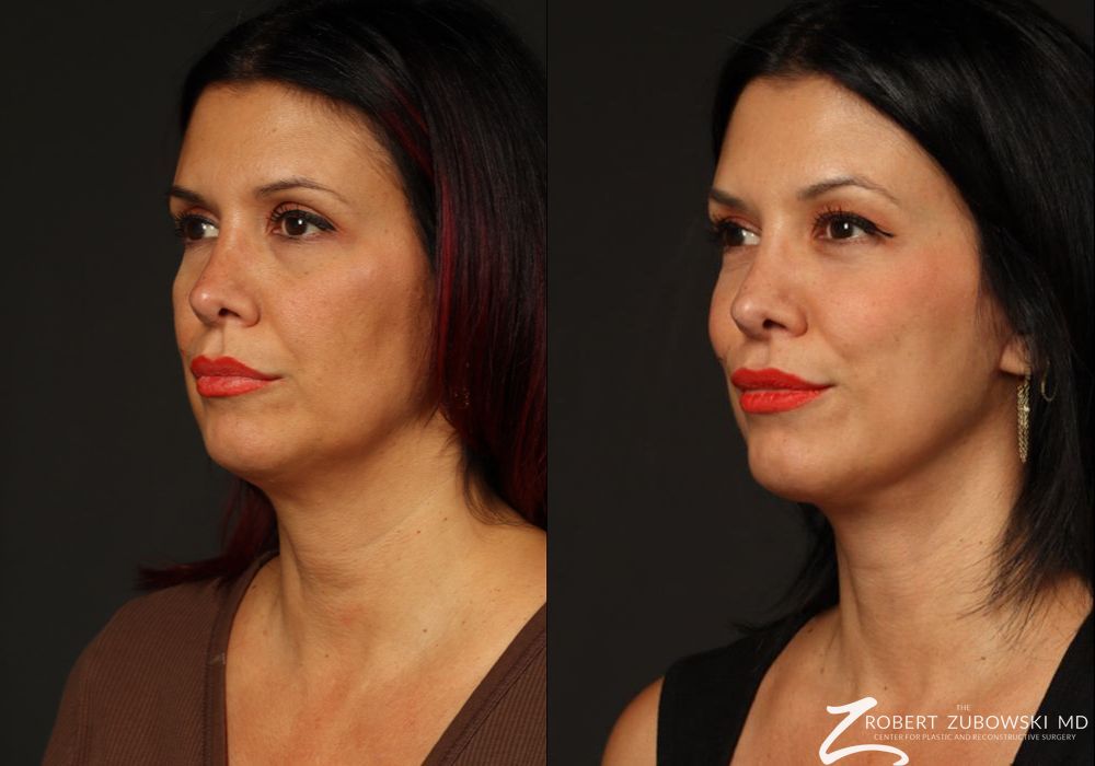 Blepharoplasty - Thumbnail 2