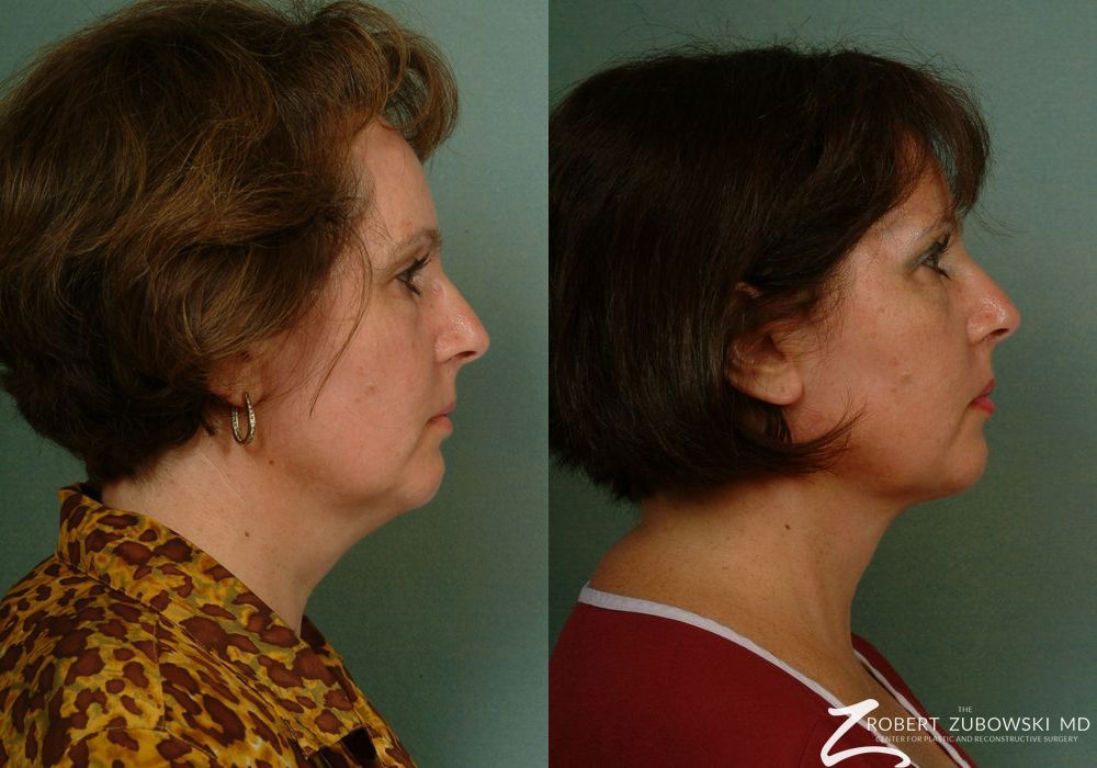 Neck Lift - Thumbnail 3