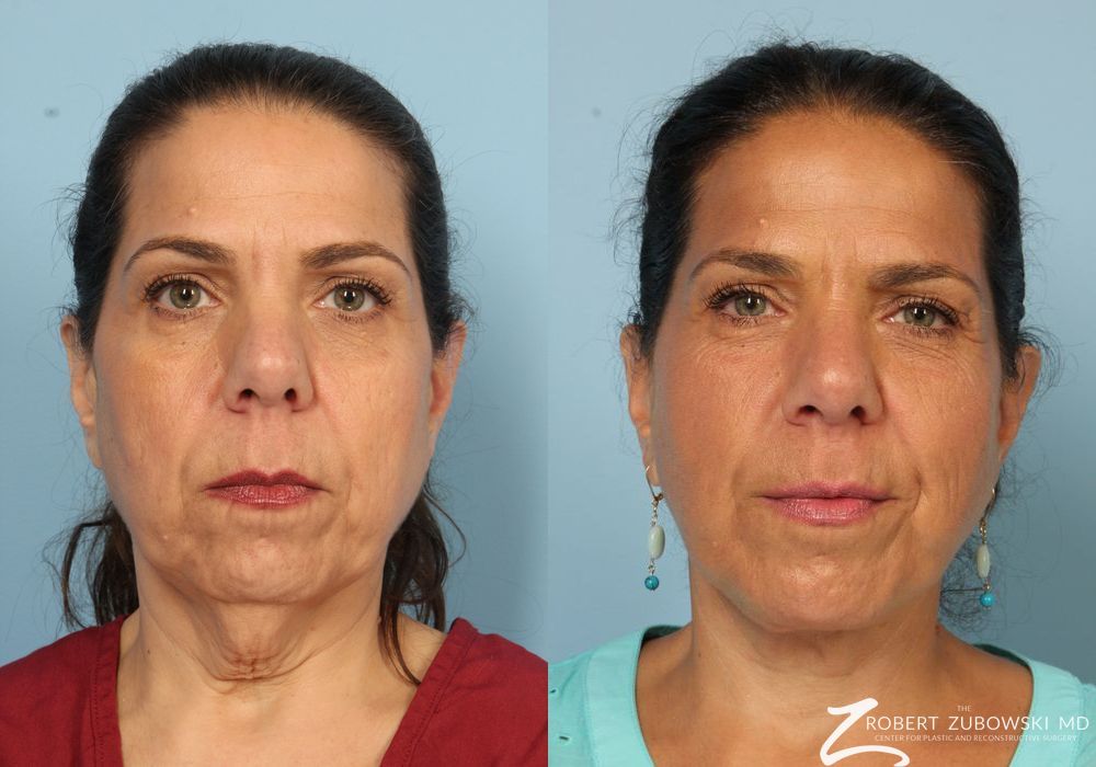 Neck Lift - Case 3850