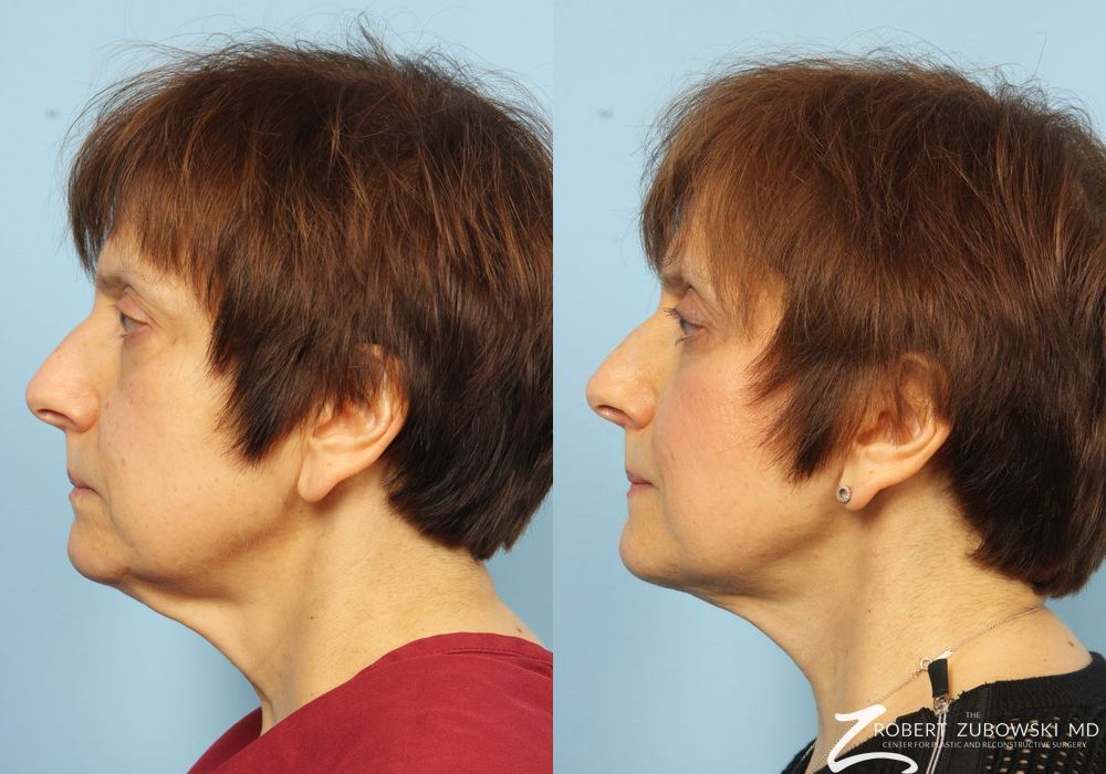 Neck Lift - Thumbnail 3