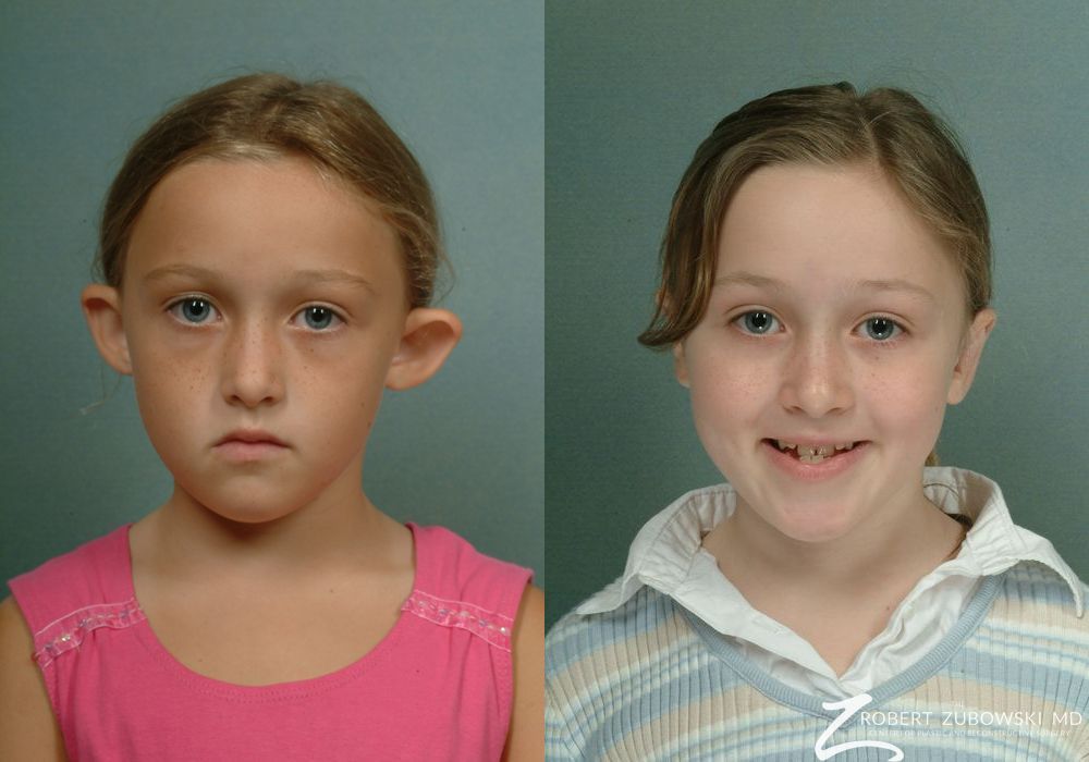 Otoplasty - Case 3854