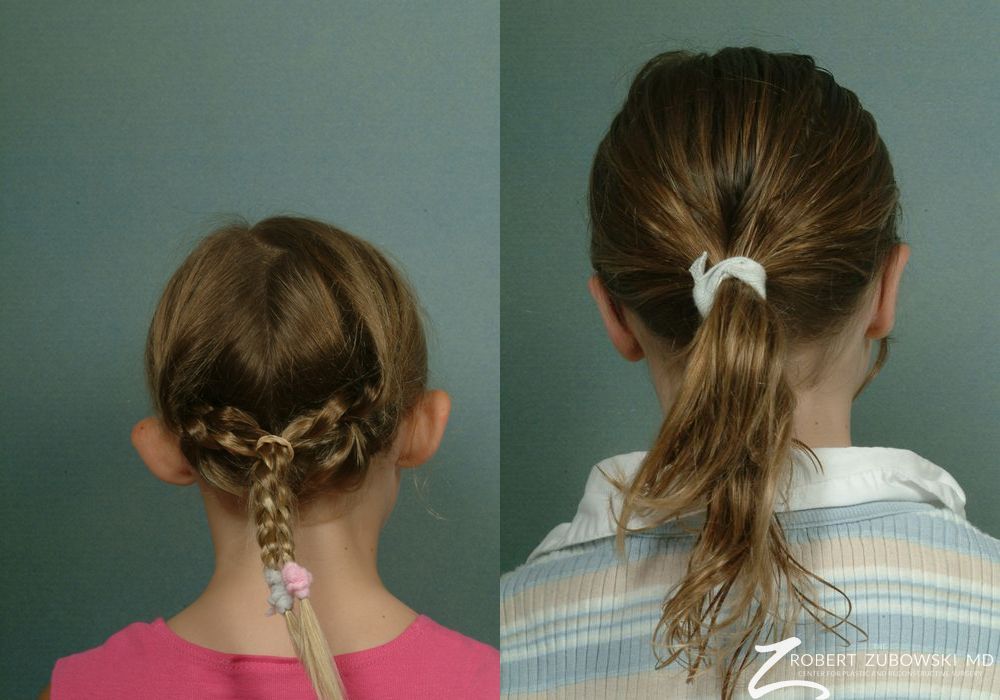 Otoplasty - Thumbnail 2