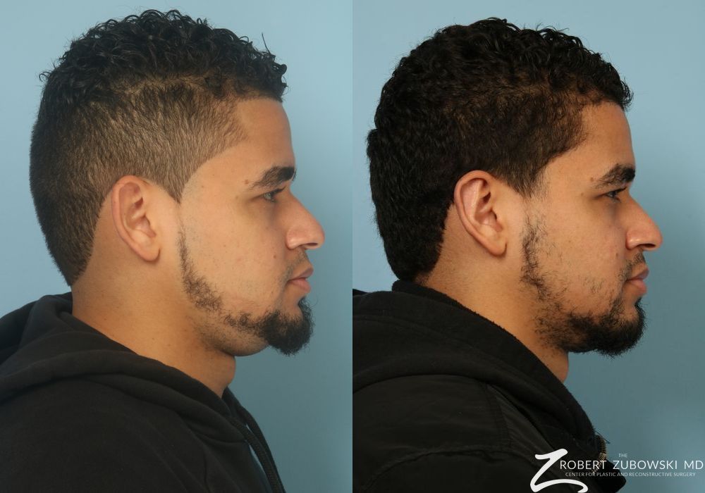 Otoplasty - Thumbnail 2