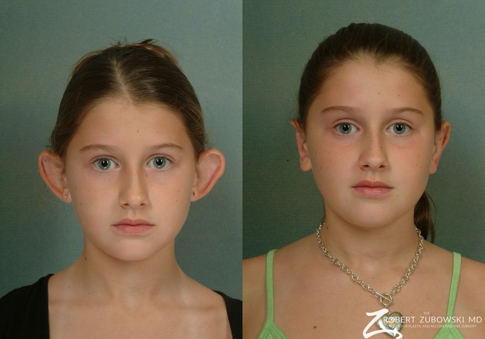 Otoplasty - Case 3856