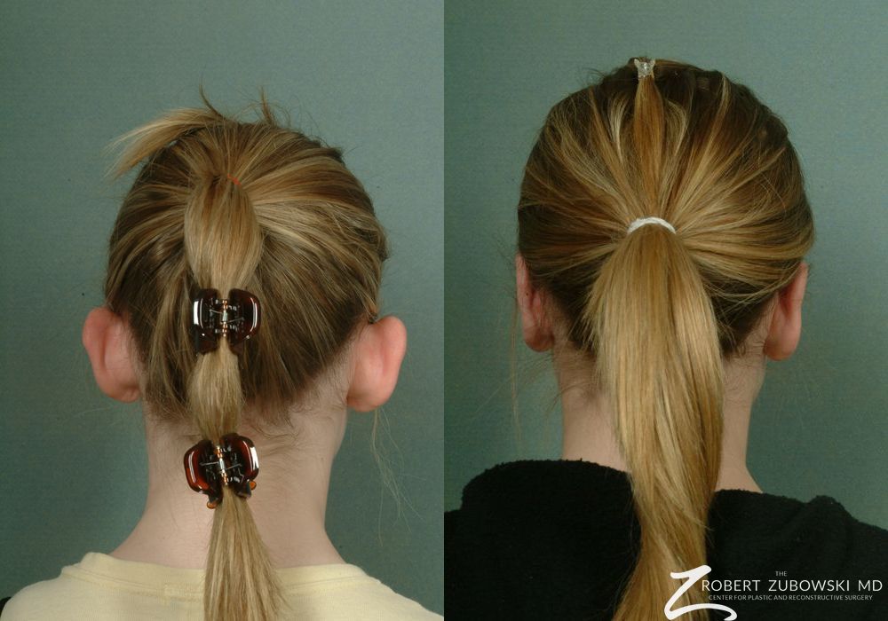 Otoplasty - Thumbnail 2