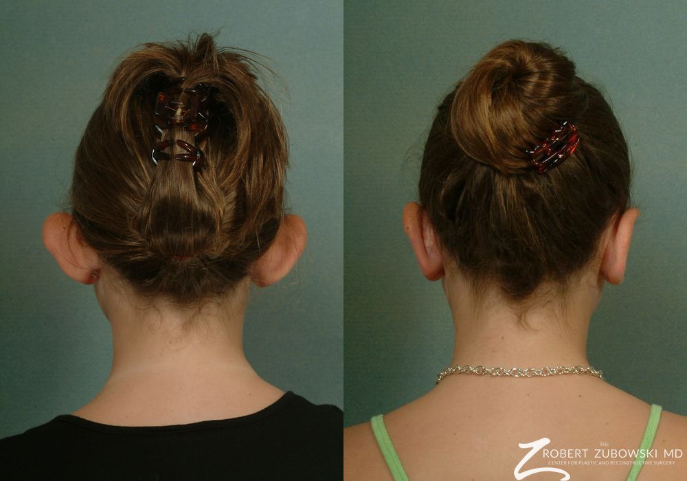 Otoplasty - Thumbnail 2