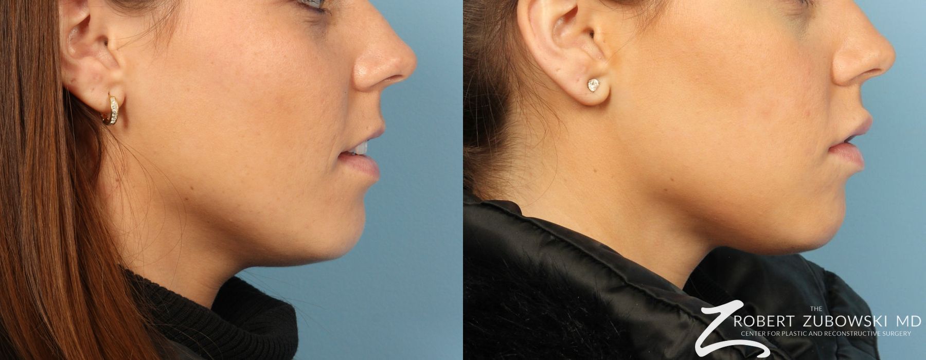 Before and after Permanent Lip Enhancement case 8561 - Angle 2