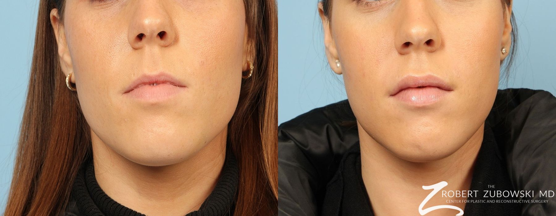 Permanent Lip Enhancement - Case 3861