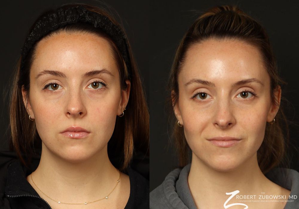 Before and after procedure result