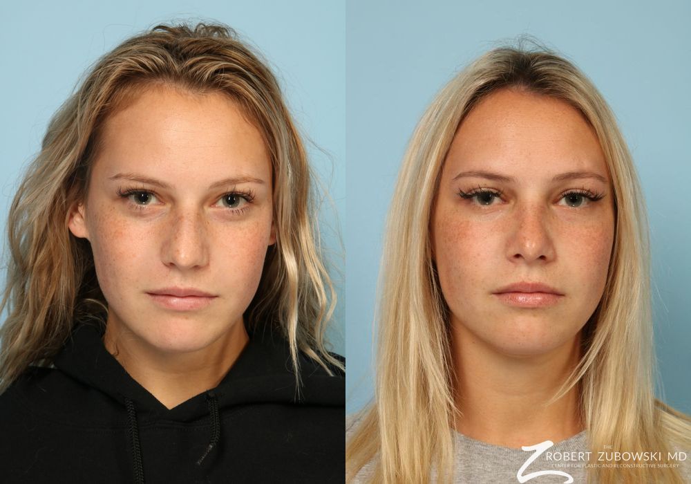 Rhinoplasty - Case 3898