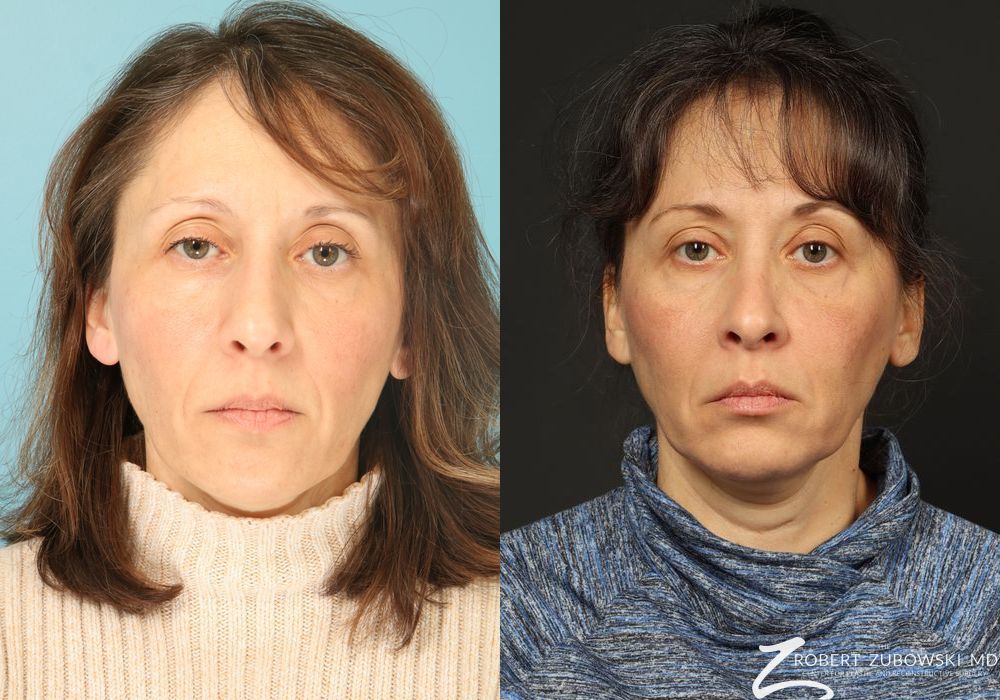 Rhinoplasty - Case 3874