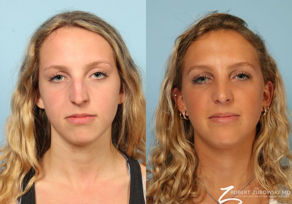 Before and after procedure result