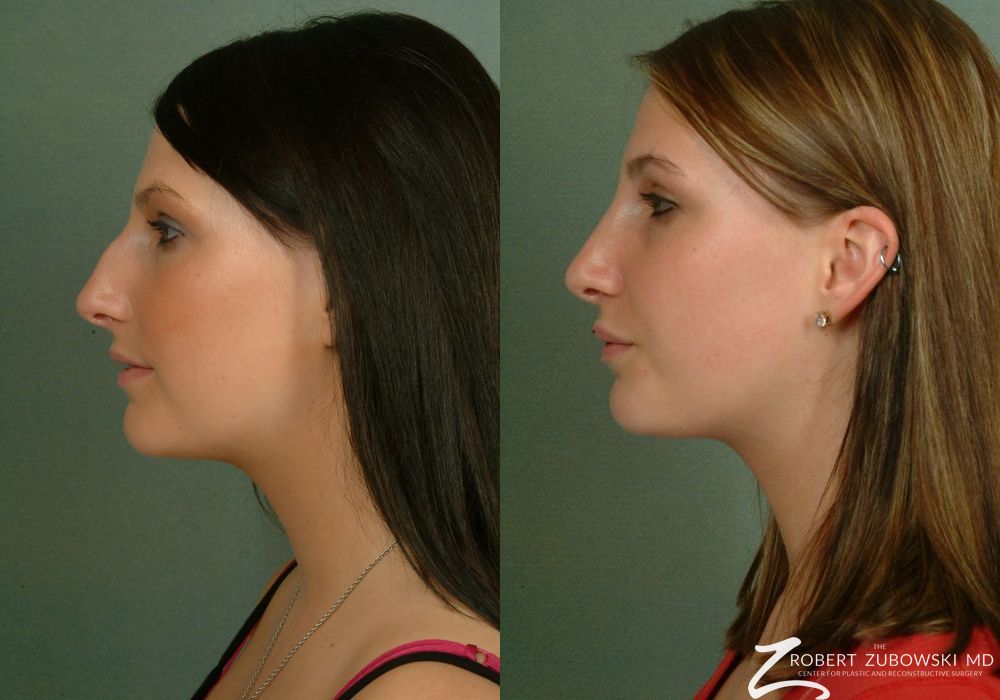 Rhinoplasty - Thumbnail 2