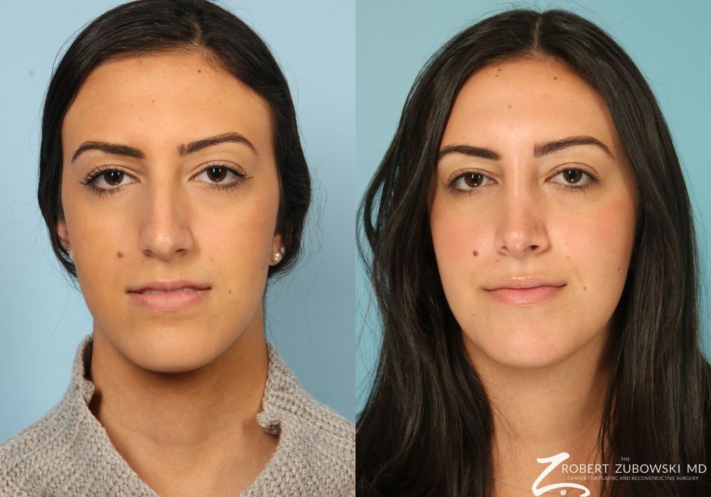 Rhinoplasty - Case 3879