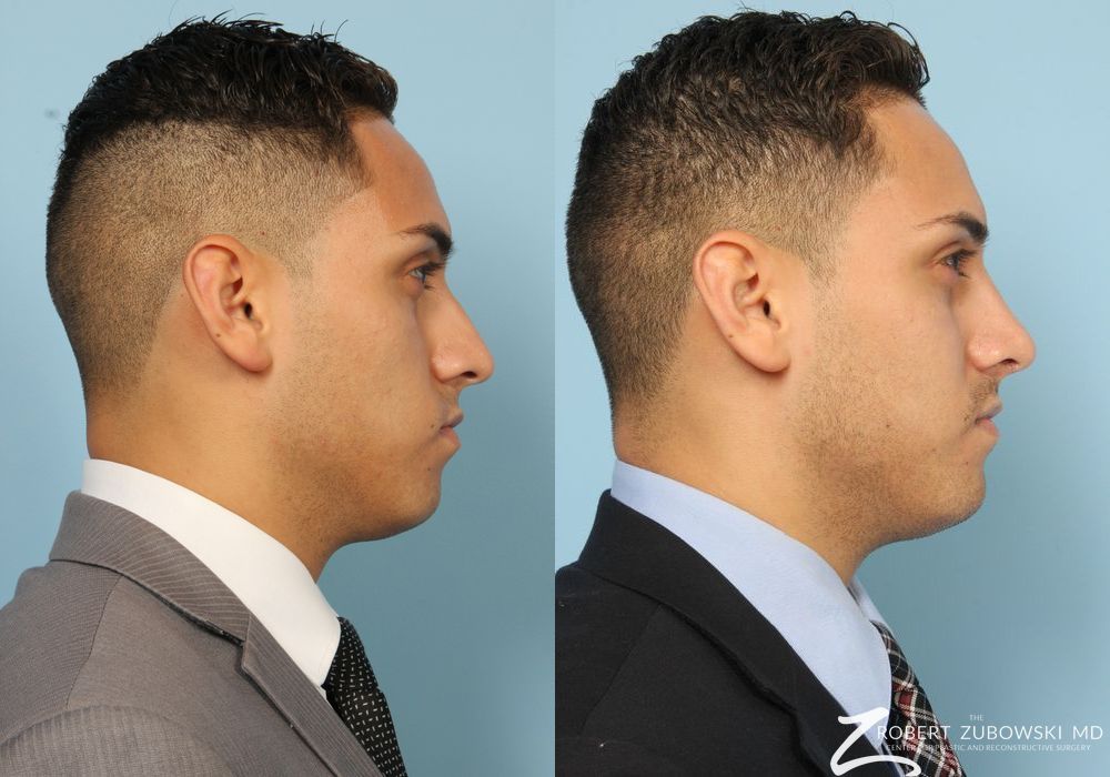 Before and after Rhinoplasty case 8172 - Angle 2