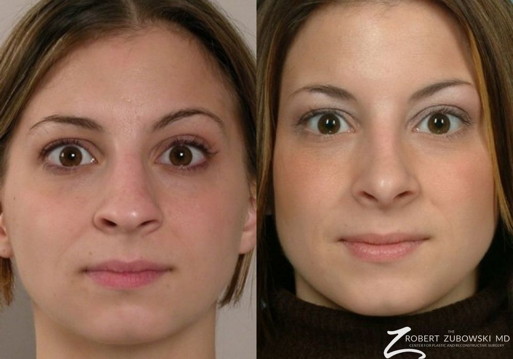 Rhinoplasty - Case 3890