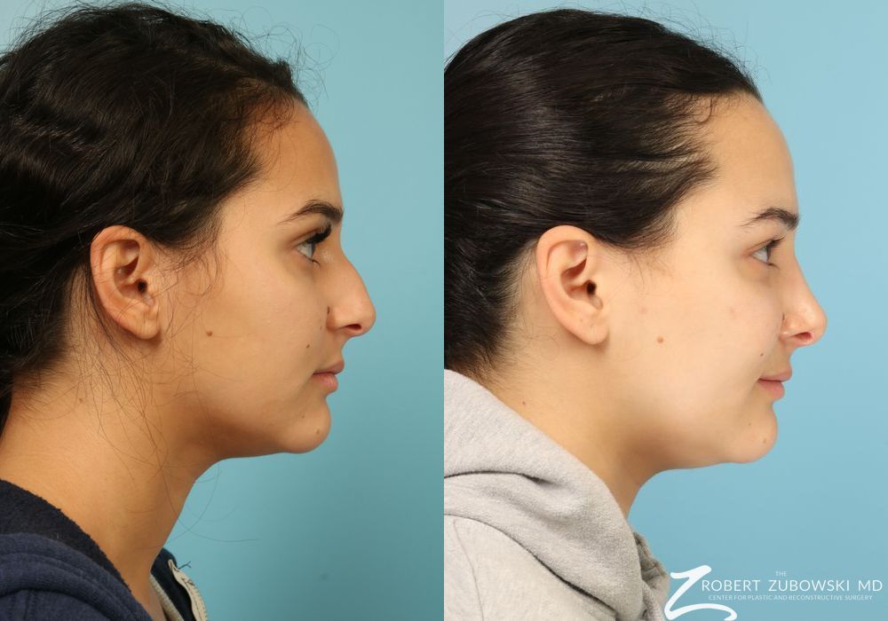 Rhinoplasty - Thumbnail 2