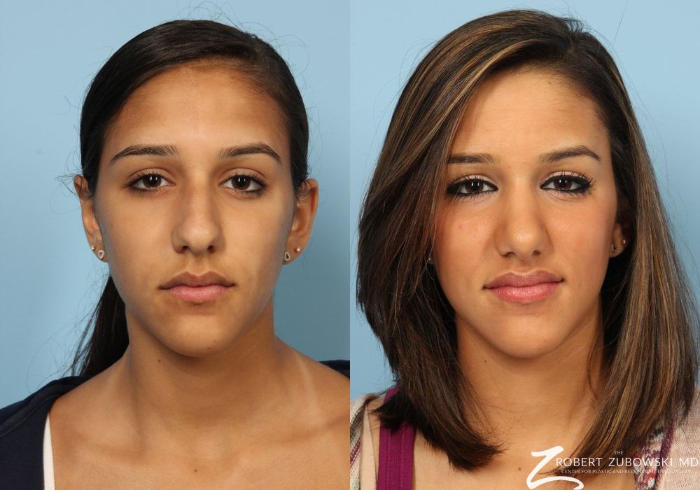 Rhinoplasty - Case 3876