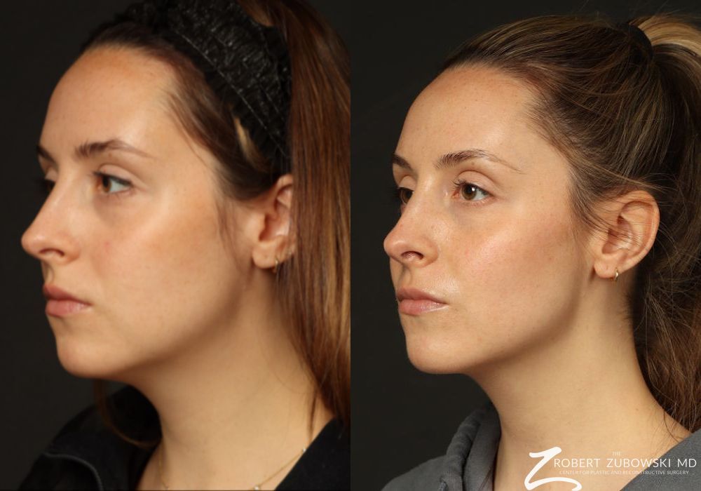 Rhinoplasty - Thumbnail 2