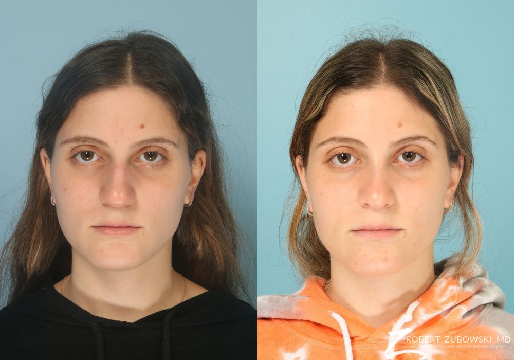 Before and after procedure result