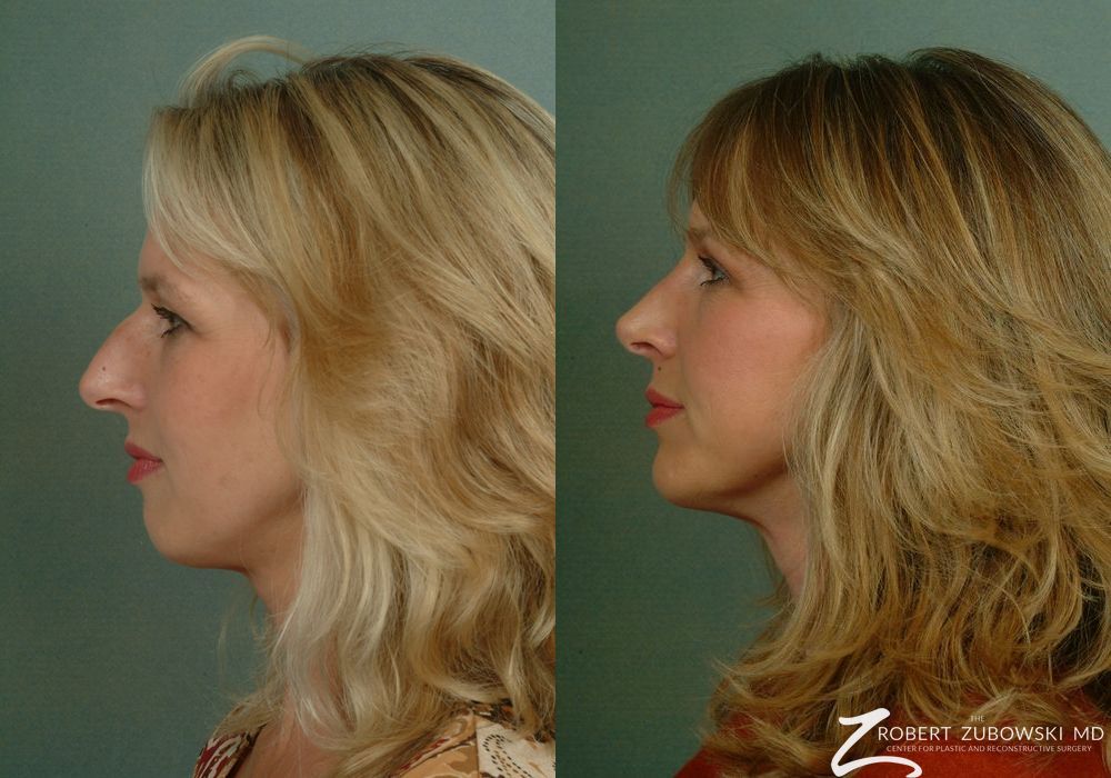 Rhinoplasty - Thumbnail 2