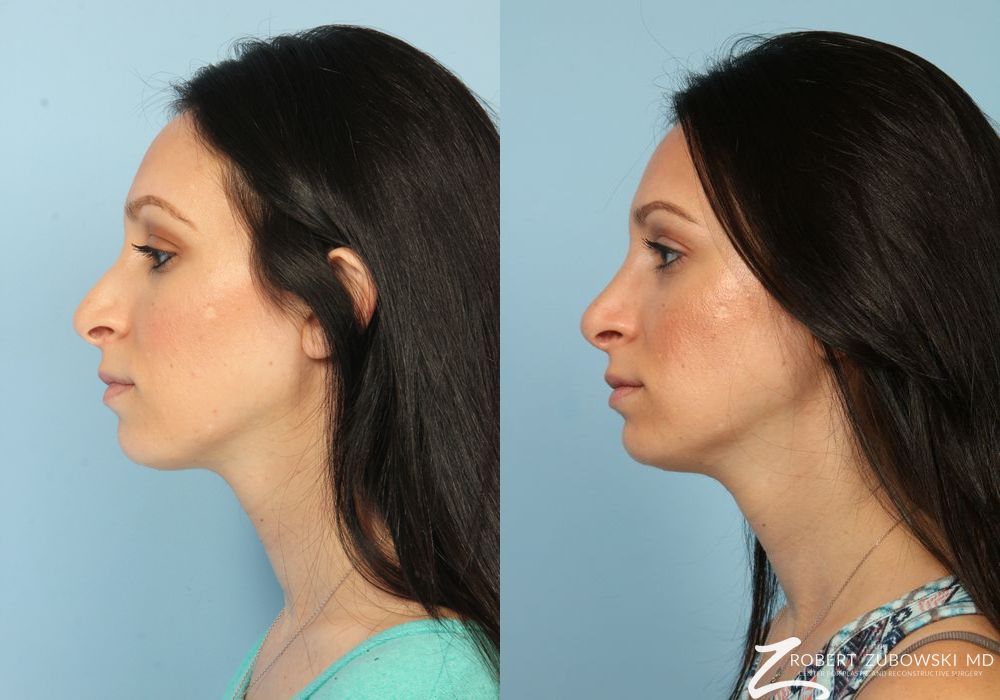 Rhinoplasty - Thumbnail 2