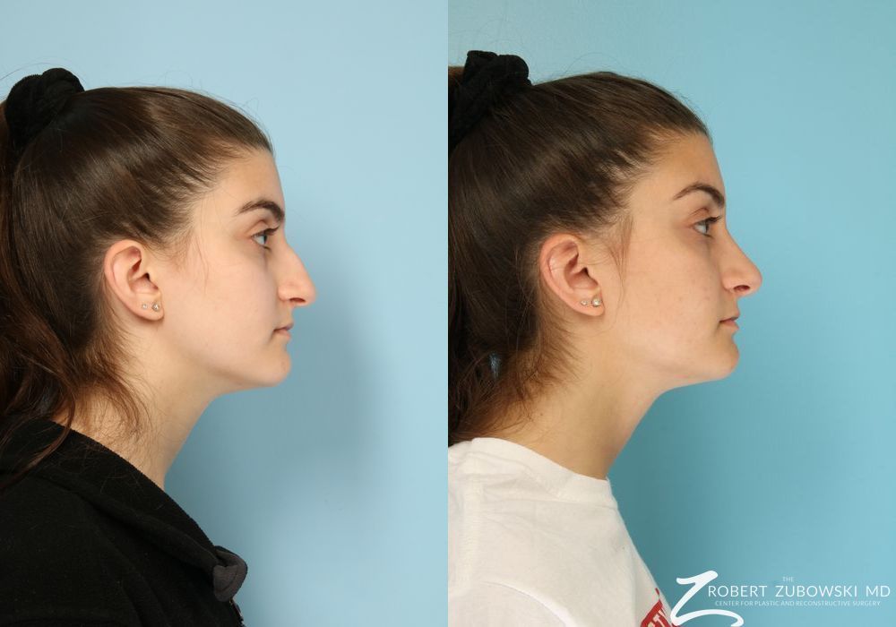 Rhinoplasty - Thumbnail 2