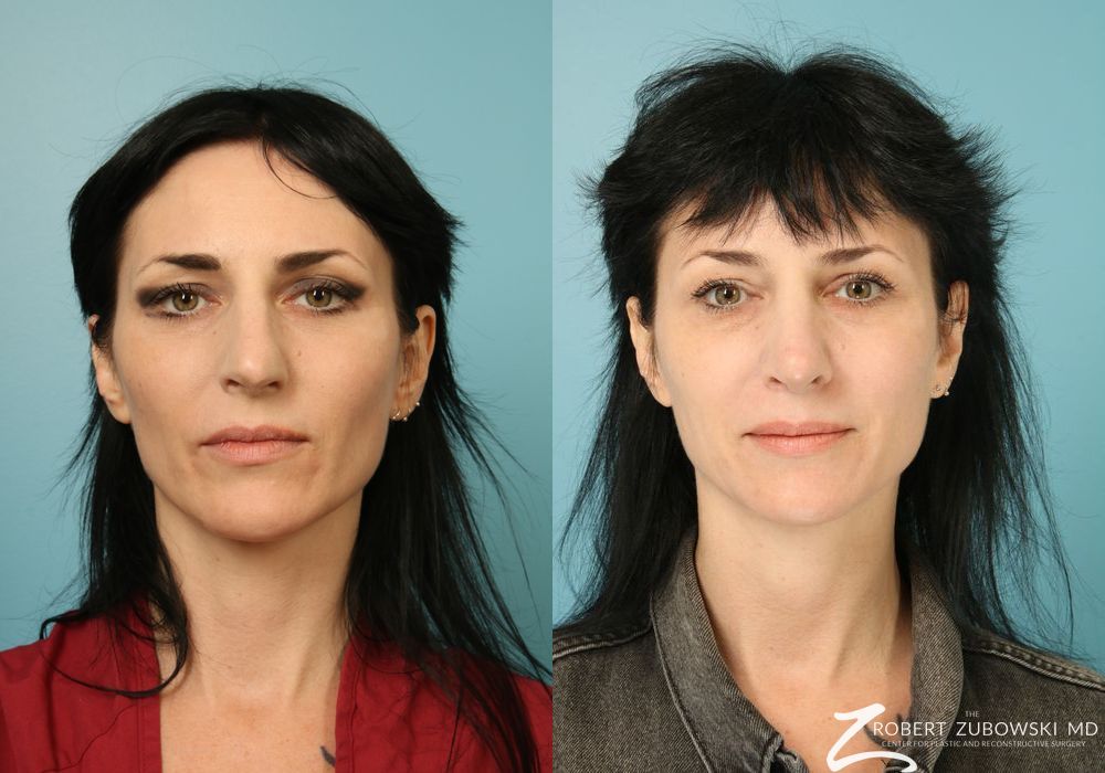 Rhinoplasty - Case 3872