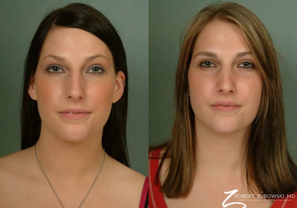 Rhinoplasty - Case 3882