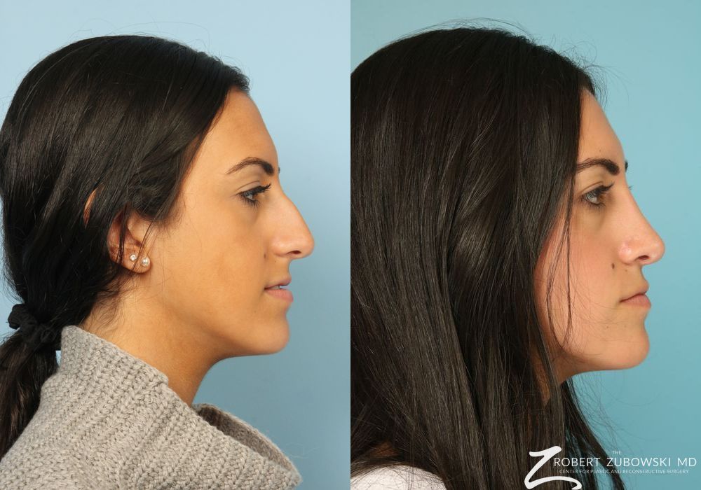 Rhinoplasty - Thumbnail 2