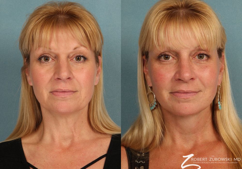 Rhinoplasty - Case 3887