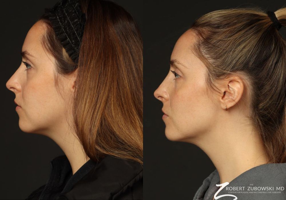 Rhinoplasty - Thumbnail 3