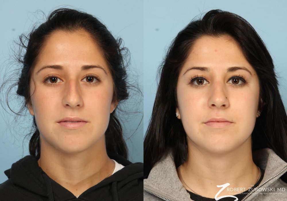 Before and after procedure result