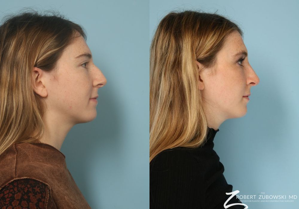 Rhinoplasty - Thumbnail 2