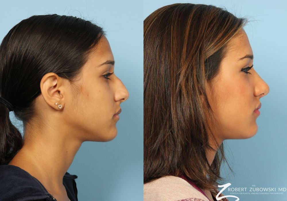 Rhinoplasty - Thumbnail 2