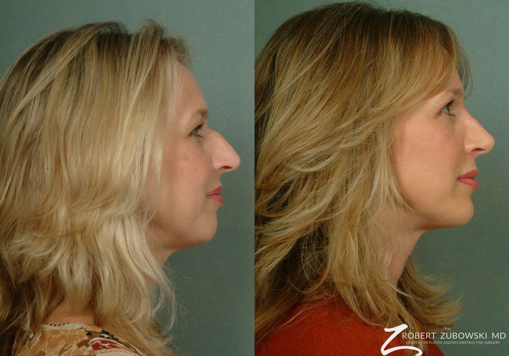 Rhinoplasty - Thumbnail 3