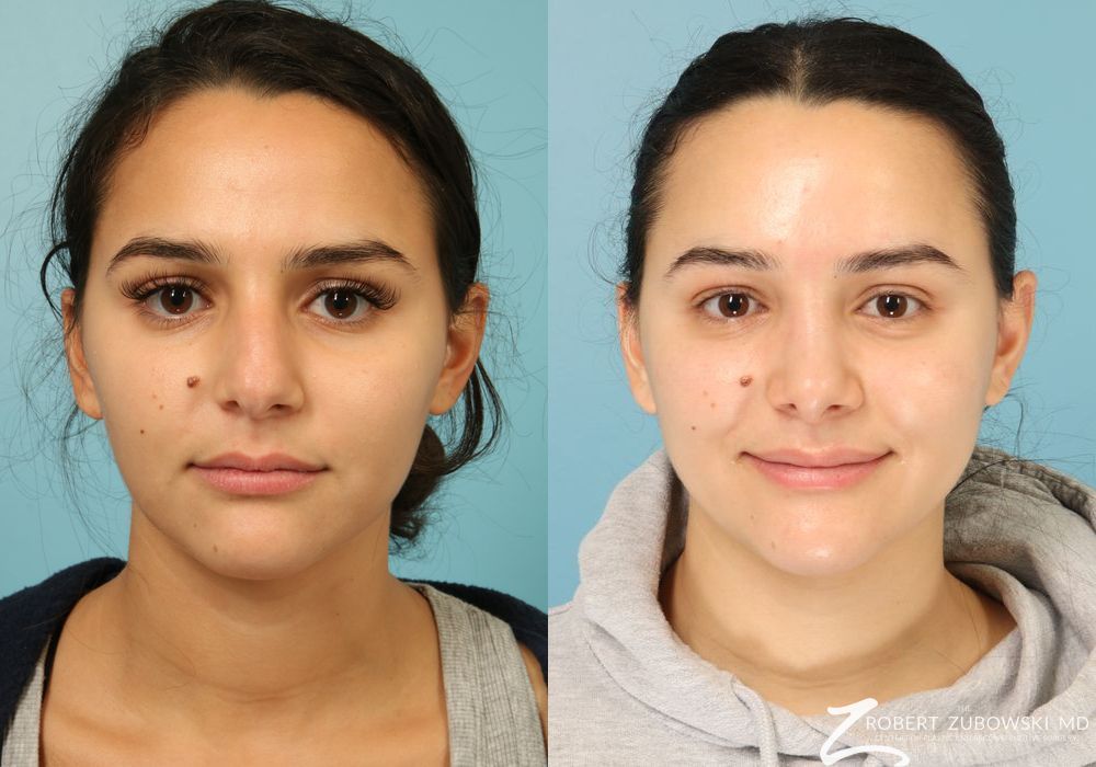 Rhinoplasty - Case 3871
