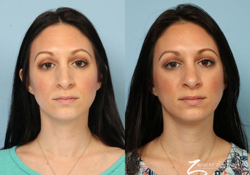 Rhinoplasty - Case 3897