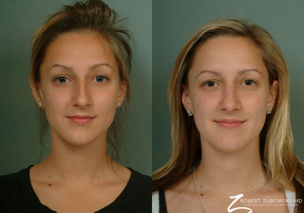 Rhinoplasty - Case 3875