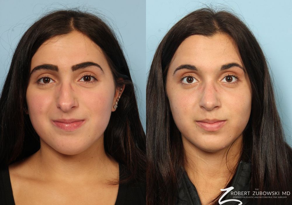 Before and after procedure result