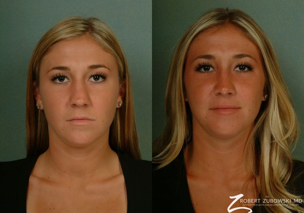 Rhinoplasty - Case 3881