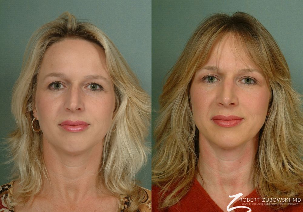 Rhinoplasty - Case 3891