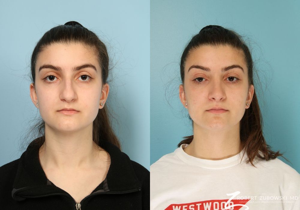 Rhinoplasty - Case 3877