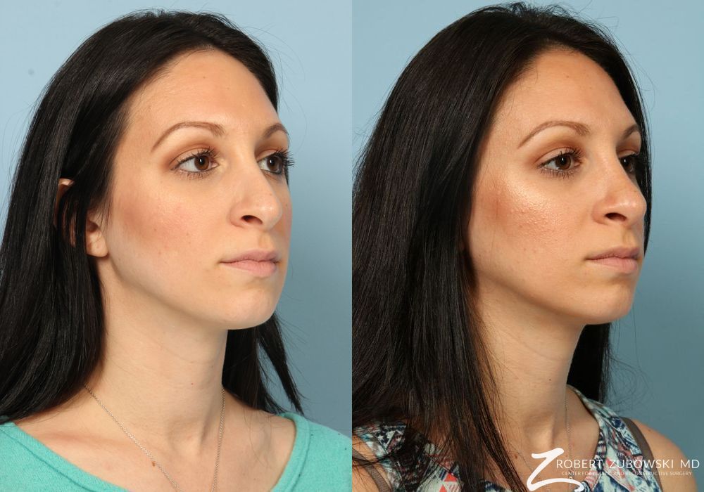 Rhinoplasty - Thumbnail 3