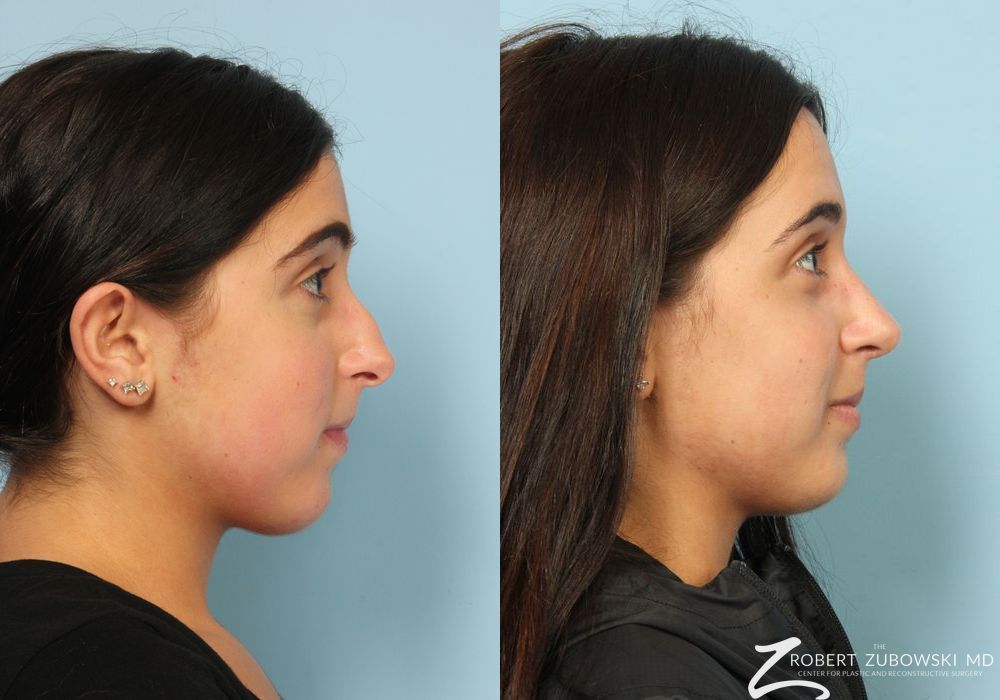 Rhinoplasty - Thumbnail 2