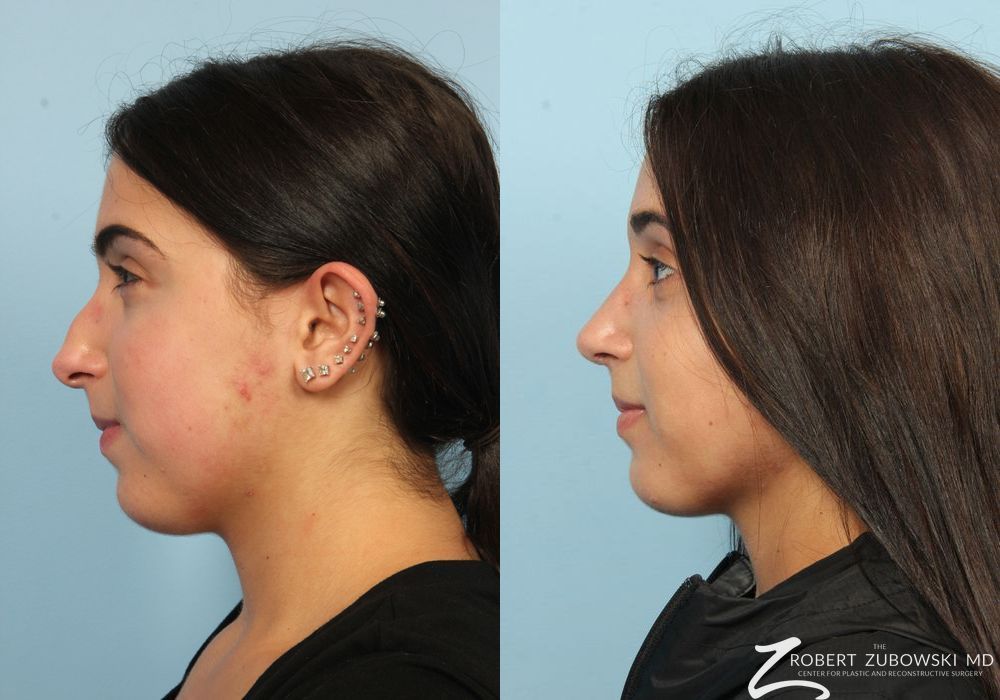 Rhinoplasty - Thumbnail 3